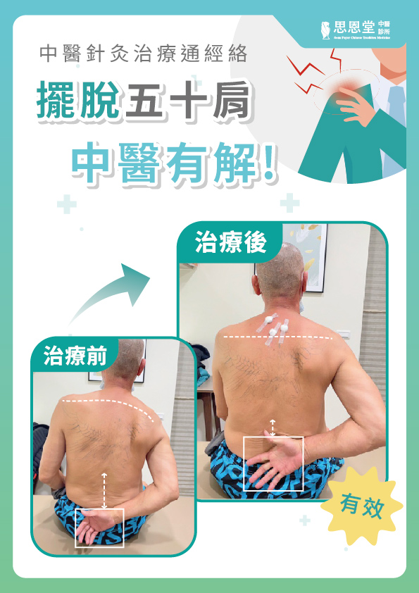 高雄五十肩