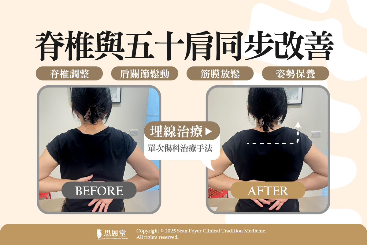 高雄五十肩治療推薦